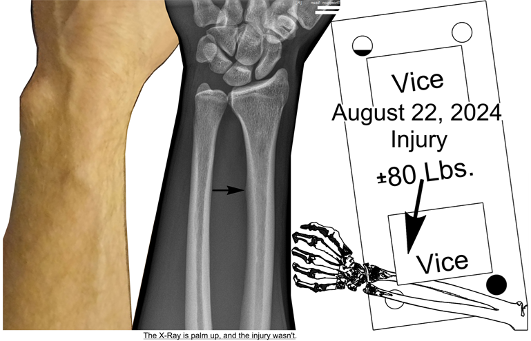 Radius Bone Abnormality At Injury Location